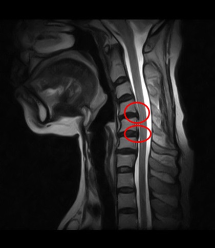 頸椎椎間板ヘルニアの画像